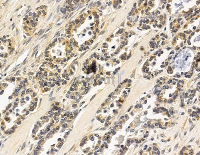 AS3MT Antibody - DF14946 at 1/100 staining human ovarian cancer by IHC-P.