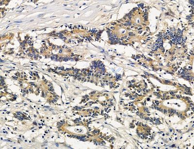 LAPTM5 Antibody - DF15005 at 1/100 staining human prostate cancer by IHC-P.