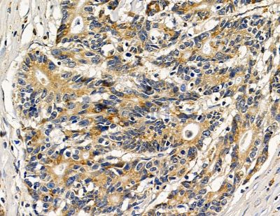 ALG5 Antibody - DF15069 at 1/100 staining human colorectal cancer by IHC-P.