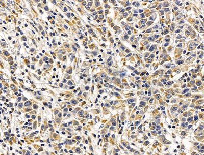 SSR2 Antibody - DF15074 at 1/100 staining human gastric cancer by IHC-P.