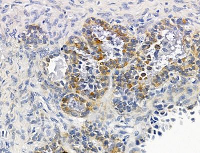 CXorf23 Antibody - DF15138 at 1/100 staining human ovarian cancer by IHC-P.
