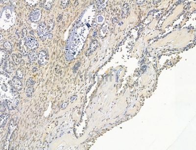 TEX15 Antibody - DF15175 at 1/100 staining human ovarian cancer and para-carcinoma tissue by IHC-P.