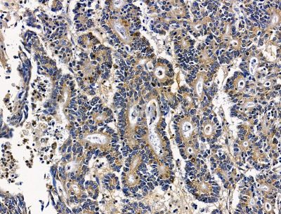C12orf65 Antibody - DF15183 at 1/100 staining human colorectal cancer by IHC-P.