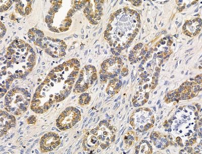 TSFM Antibody - DF15206 at 1/100 staining human ovarian cancer and para-carcinoma tissue by IHC-P.