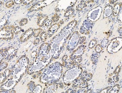 TSFM Antibody - DF15206 at 1/100 staining human ovarian cancer by IHC-P.
