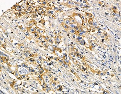 PACSIN1 Antibody - DF15266 at 1/100 staining human pancreatic cancer by IHC-P.