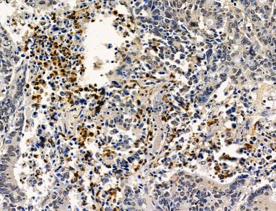 MIR22HG Antibody - DF15292 at 1/100 staining human colorectal cancer by IHC-P.