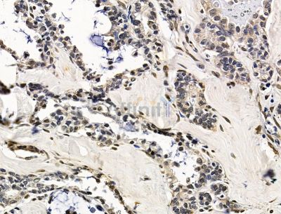 AAR2 Antibody - DF15296 at 1/100 staining human ovarian cancer by IHC-P.