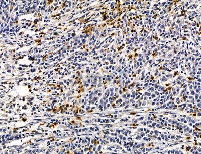 SELENOH Antibody - DF15312 at 1/100 staining human gastric cancer by IHC-P.