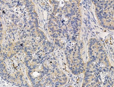 TOMM5 Antibody - DF15313 at 1/100 staining human lung cancer and para-carcinoma tissue by IHC-P.