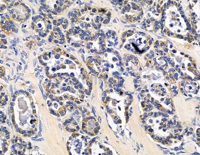 HPS6 Antibody - DF15359 at 1/100 staining human ovarian cancer by IHC-P.