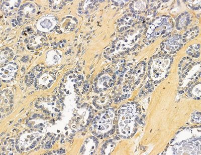 CHM Antibody - DF15370 at 1/100 staining human ovarian cancer by IHC-P.
