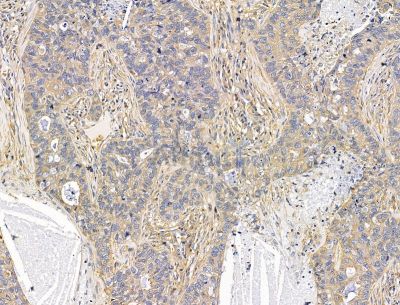 UNC45B Antibody - DF15396 at 1/100 staining human lung cancer and para-carcinoma tissue by IHC-P.
