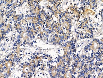 SNTG2 Antibody - DF15403 at 1/100 staining human colorectal cancer by IHC-P.