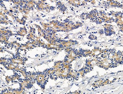 SNTG2 Antibody - DF15403 at 1/100 staining human prostate cancer by IHC-P.