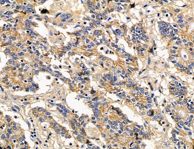 TOB2 Antibody - DF15413 at 1/100 staining human colorectal cancer by IHC-P.