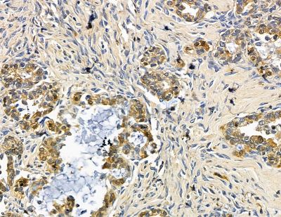 TWF2 Antibody - DF15422 at 1/100 staining human ovarian cancer by IHC-P.