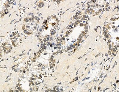 EGR4 Antibody - DF15444 at 1/100 staining human ovarian cancer by IHC-P.
