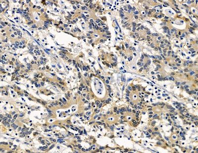 COG1 Antibody - DF15453 at 1/100 staining human colorectal cancer and para-carcinoma tissue by IHC-P.