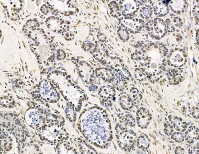 CTC1 Antibody - DF15502 at 1/100 staining human ovarian cancer by IHC-P.