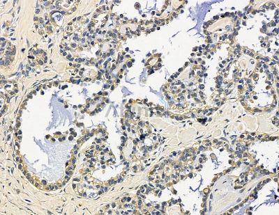 GAB3 Antibody - DF15521 at 1/100 staining human ovarian cancer by IHC-P.