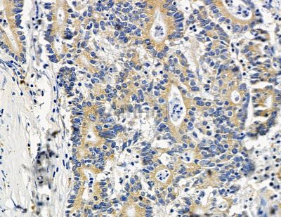 UBE2G2 Antibody - DF15540 at 1/100 staining human colorectal cancer by IHC-P.