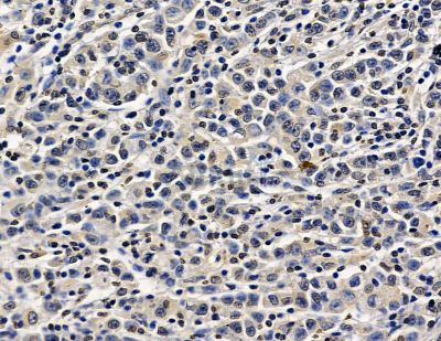 PTF1A Antibody - DF15574 at 1/100 staining human gastric cancer by IHC-P.