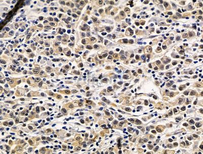 IKZF5 Antibody - DF15610 at 1/100 staining human gastric cancer by IHC-P.