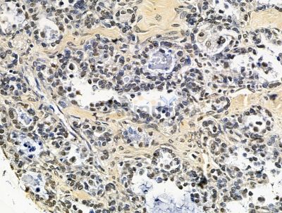 IKZF5 Antibody - DF15610 at 1/100 staining human ovarian cancer by IHC-P.