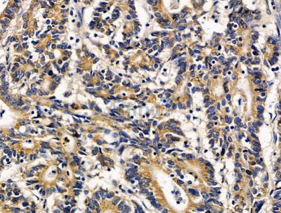 SPPL2B Antibody - DF15613 at 1/100 staining human colorectal cancer by IHC-P.