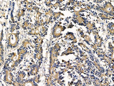 CAPN15 Antibody - DF15614 at 1/100 staining human colorectal cancer by IHC-P.