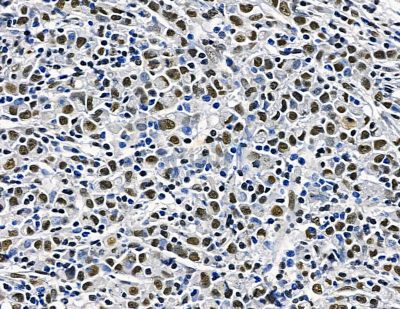 TLX2 Antibody - DF15646 at 1/100 staining human gastric cancer and para-carcinoma tissue by IHC-P.