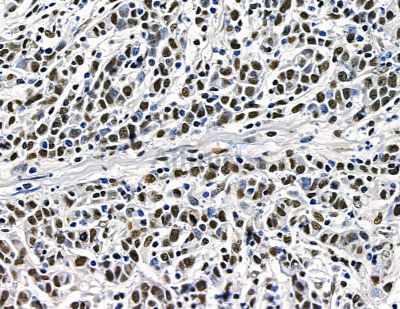 TLX2 Antibody - DF15646 at 1/100 staining human gastric cancer by IHC-P.