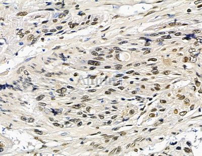 TLX2 Antibody - DF15646 at 1/100 staining human esophageal cancer by IHC-P.
