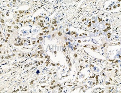 TLX2 Antibody - DF15646 at 1/100 staining human pancreatic cancer and para-carcinoma tissue by IHC-P.