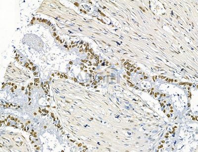 TLX2 Antibody - DF15646 at 1/100 staining human pancreatic cancer by IHC-P.