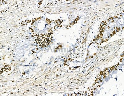 TLX2 Antibody - DF15646 at 1/100 staining human pancreatic cancer by IHC-P.