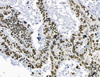 TLX2 Antibody - DF15646 at 1/100 staining human ovarian cancer by IHC-P.