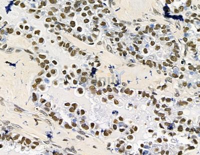 TLX2 Antibody - DF15646 at 1/100 staining human ovarian cancer by IHC-P.