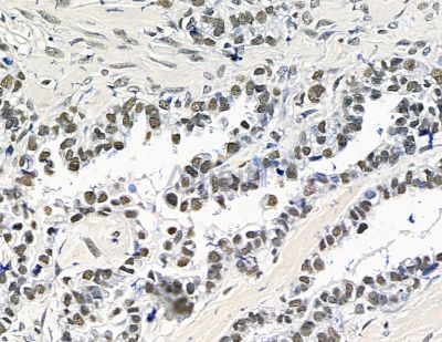 TLX2 Antibody - DF15646 at 1/100 staining human ovarian cancer by IHC-P.