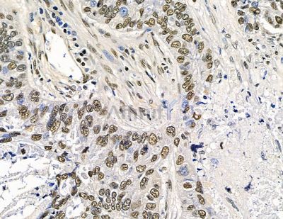 TLX2 Antibody - DF15646 at 1/100 staining human lung cancer and para-carcinoma tissue by IHC-P.