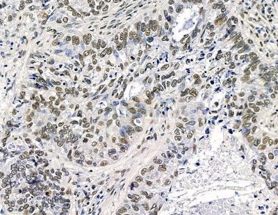 TLX2 Antibody - DF15646 at 1/100 staining human lung cancer by IHC-P.
