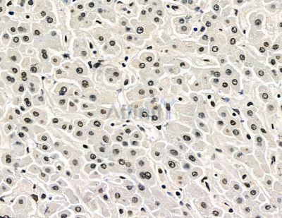 TLX2 Antibody - DF15646 at 1/100 staining human liver cancer by IHC-P.