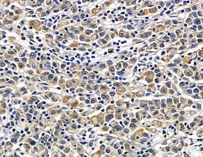 TMEM5 Antibody - DF15656 at 1/100 staining human gastric cancer by IHC-P.