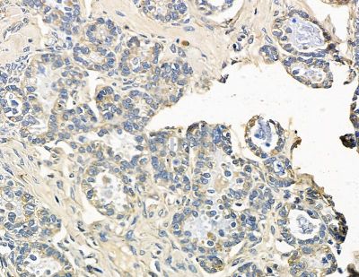 TASP1 Antibody - DF15665 at 1/100 staining human ovarian cancer by IHC-P.