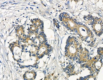 RPN2 Antibody - DF15676 at 1/100 staining human prostate cancer by IHC-P.