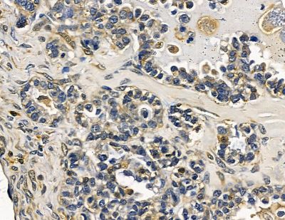 SLITRK1 Antibody - DF15695 at 1/100 staining human ovarian cancer by IHC-P.