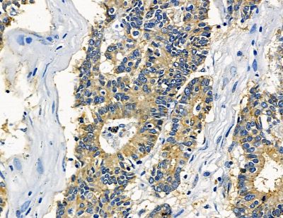 FNBP1L Antibody - DF15700 at 1/100 staining human colorectal cancer by IHC-P.
