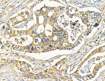 FNBP1L Antibody - DF15700 at 1/100 staining human pancreatic cancer and para-carcinoma tissue by IHC-P.
