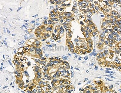 FNBP1L Antibody - DF15700 at 1/100 staining human ovarian cancer by IHC-P.